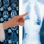 Zωντανός χωρίς πνεύμονες για 48 ώρες: Άνδρας επιβίωσε με τεχνητούς μέχρι τη μεταμόσχευση